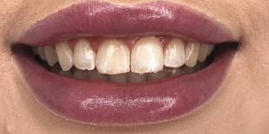 In Chair Teeth Whitening Before After 1