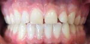 Clear Aligners Before 1