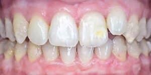 Veneers Before