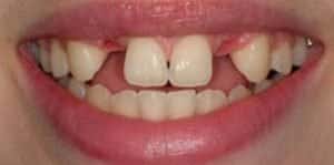 Before Dental Implants