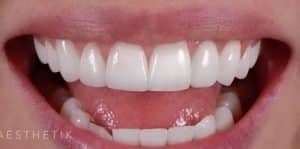 Veneers After
