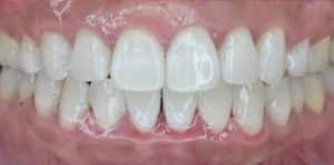 Clear Aligners After