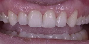 Veneers Before