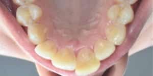Clear Aligners Before