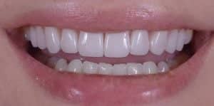 Veneers After