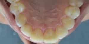 Clear Aligners After