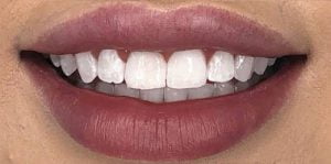 In Chair Teeth Whitening Before After 2