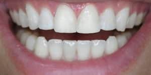 Clear Aligners After 1