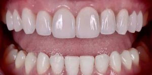 Veneers After