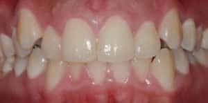 Clear Aligners Before