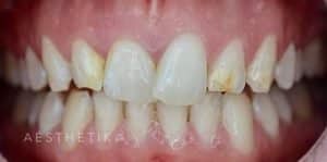 Veneers Before