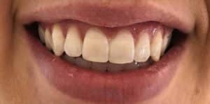 In Chair Teeth Whitening Before 3