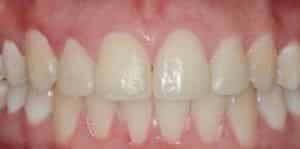 Clear Aligners After
