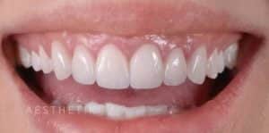 Veneers After