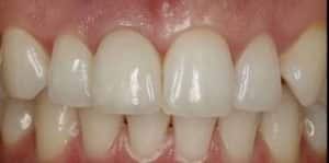After Dental Implants