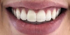 In Chair Teeth Whitening After 3