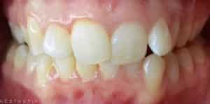 Clear Aligners Before