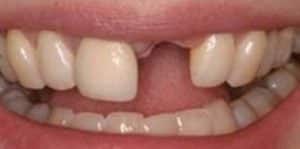 Before Dental Implants