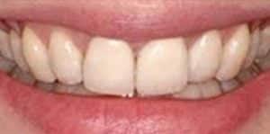 After Dental Implants