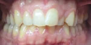 Clear Aligners Before