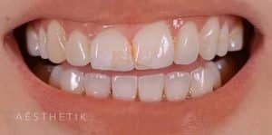 Veneers Before