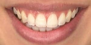 In Chair Teeth Whitening Before 4