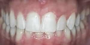 Clear Aligners After