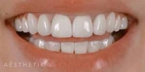 Veneers After