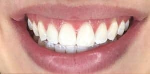 In Chair Teeth Whitening Before 4