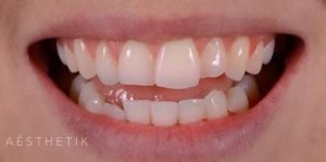 Veneers Before