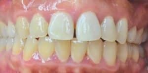 Clear Aligners Before
