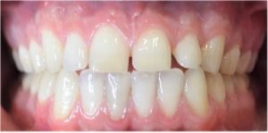 before and after teeth alignment