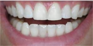 Before Teeth Whitening