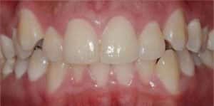 before and after teeth alignment