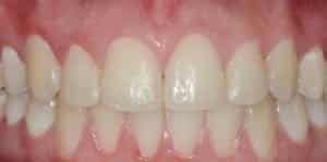 Before Whitening