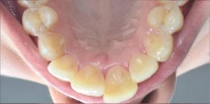 Before Invisalign