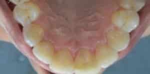 before and after teeth alignment
