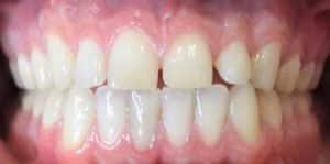 before and after teeth alignment