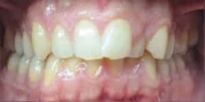before and after teeth alignment