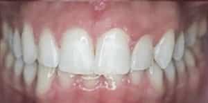 before and after teeth alignment