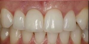 After Dental Implants