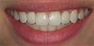 After Dental Implants