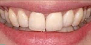 After Dental Implants