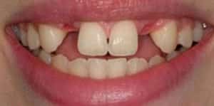 Before Teeth Implants