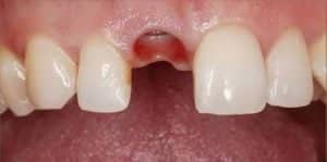 Before Dental Implants