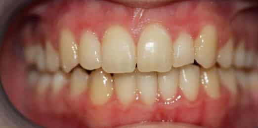Teeth Whitening Before