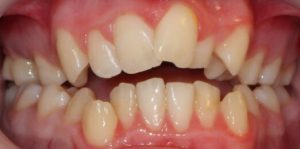 Teeth Align Before