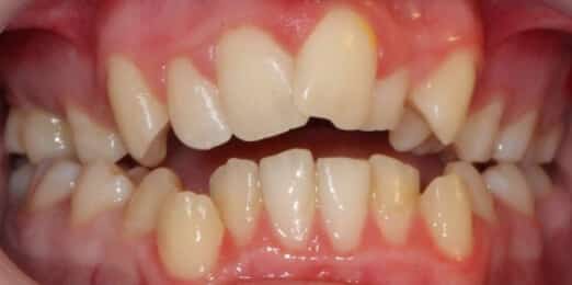 Teeth Align Before