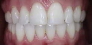 Teeth Whitening Before