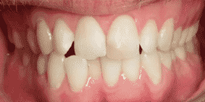 Teeth Align Before